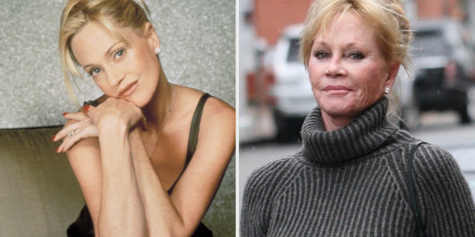 Sztárok, akiknek tönkretette a karrierjét a plasztika: Melanie Griffith és Jennifer Gray is bánja a műtéteket
