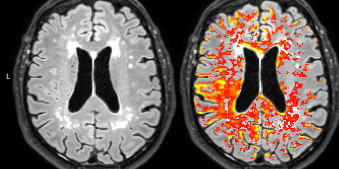 A vér-agy gát szivárgása is hozzájárul az Alzheimer-kórhoz