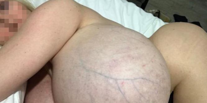 36 kilós mellei miatt haldoklik Andrea
