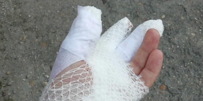 Letépte a fotós kezét az ajándék petárda