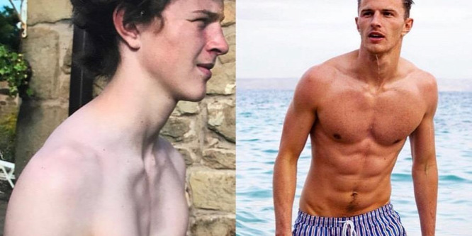 David James Seed mellkas-deformációval született, ma már a Calvin Klein modellje