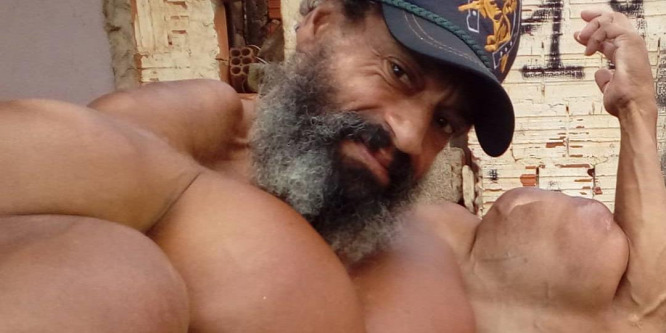 Ez a férfi olajat fecskendez a bicepszébe, hogy izmosabbnak tűnjön