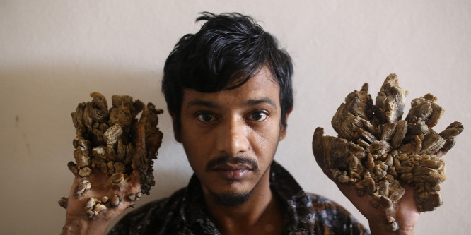 Amputáltatni akarja a kezeit a faember-szindrómával küzdő bangladesi férfi