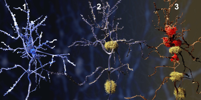 Itt a magyarázat arra, miért gyakoribb az Alzheimer-kór a nőknél