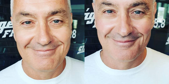 Abaházi Csaba arckezeléssel fiatalítja bőrét