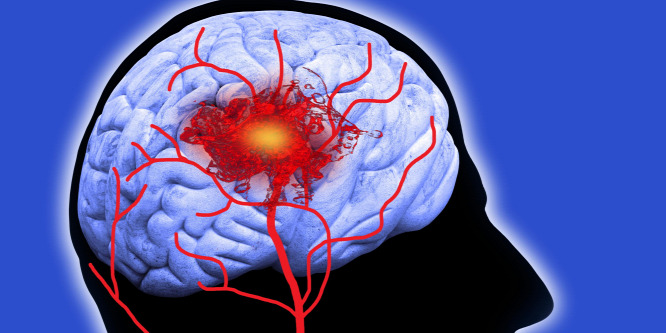 Öröklött stroke: okozhatja-e családi hajlam a szélütést?