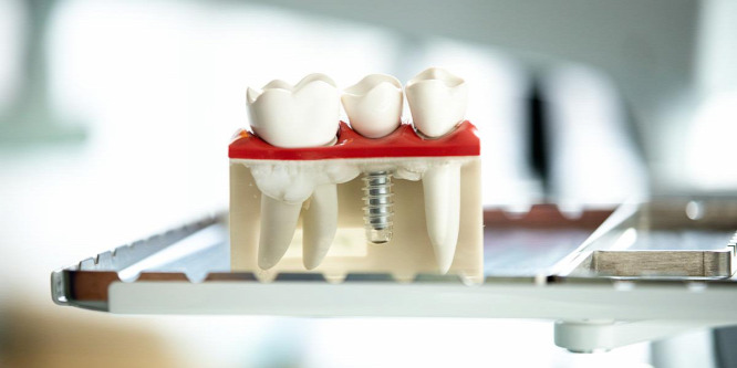 A kivehető protézistől a titán implantátumig