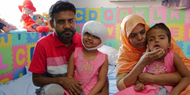 Sürgősen műteni kell a szétválasztott bangladesi sziámi ikerpár egyik tagját