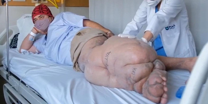 Egy szúnyogcsípéstől óriásira duzzadó testrészek: ilyen szörnyű betegség az elephantiasis