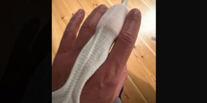 Egy dán sportújságíró sokkot kapott egy görög kórházban, ahol a cafatokra szakadt ujját műtötték