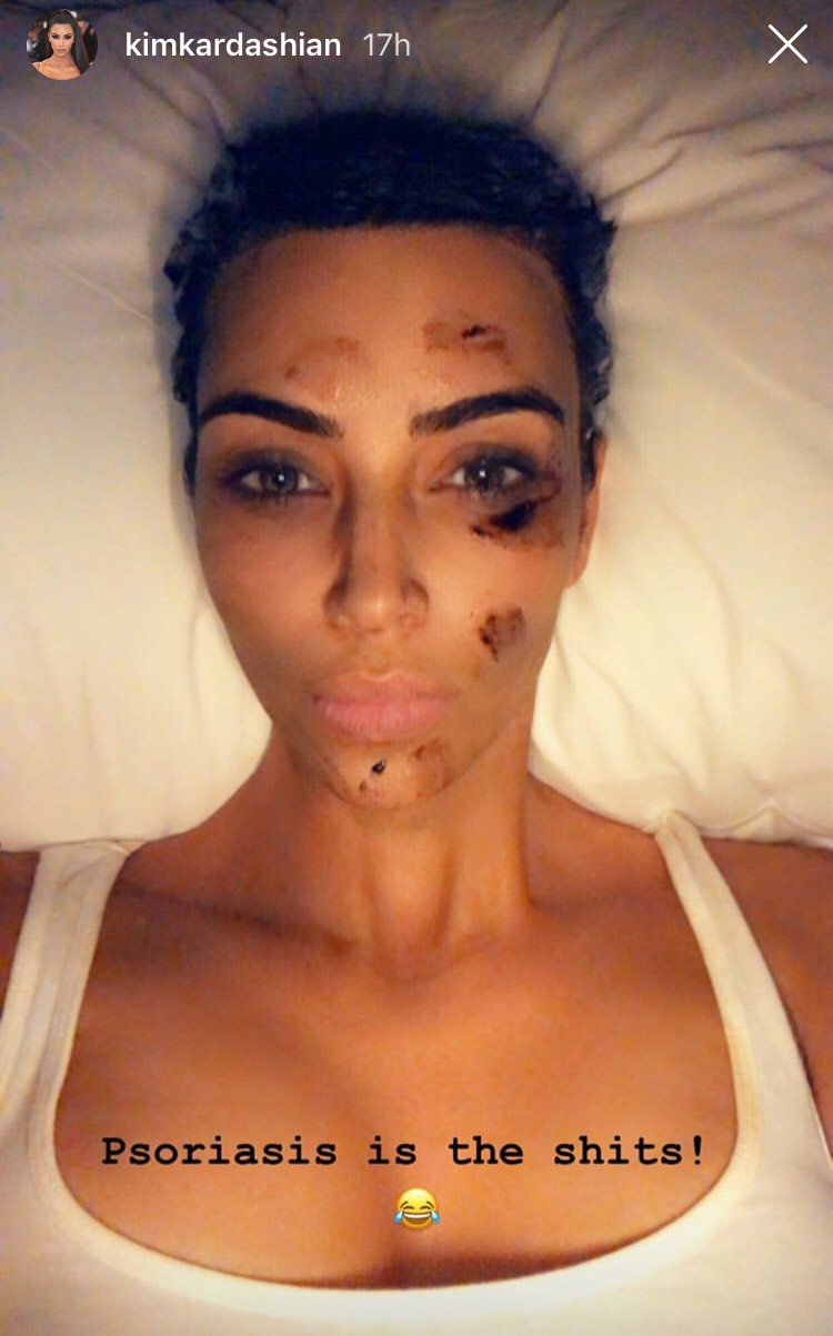 kim kardashian pikkelysömörben szenved fotó vörös száraz foltok a testen viszketnek