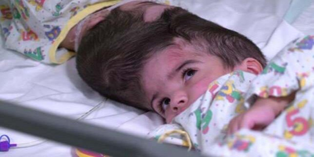 Forrás: https://www.theguardian.com/society/2019/jul/15/conjoined-twins-separated-great-ormond-street-safa-marwa